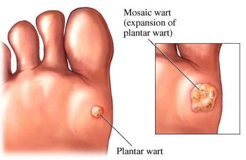 Verruca plantare