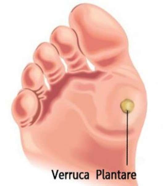 Verruche sulla pianta del piede