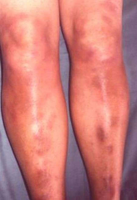 Malattia infiammatoria alle gambe