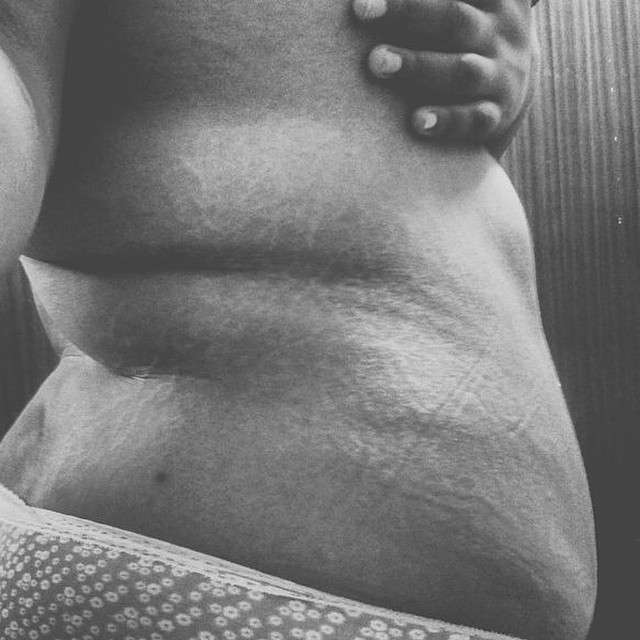 Un corpo sovrappeso