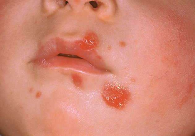 Bambino colpito dall'impetigine