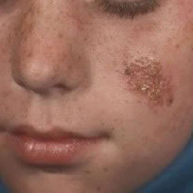 Crosta lasciata dall'impetigine