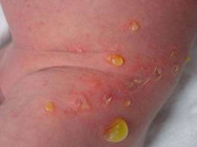 Impetigine bollosa