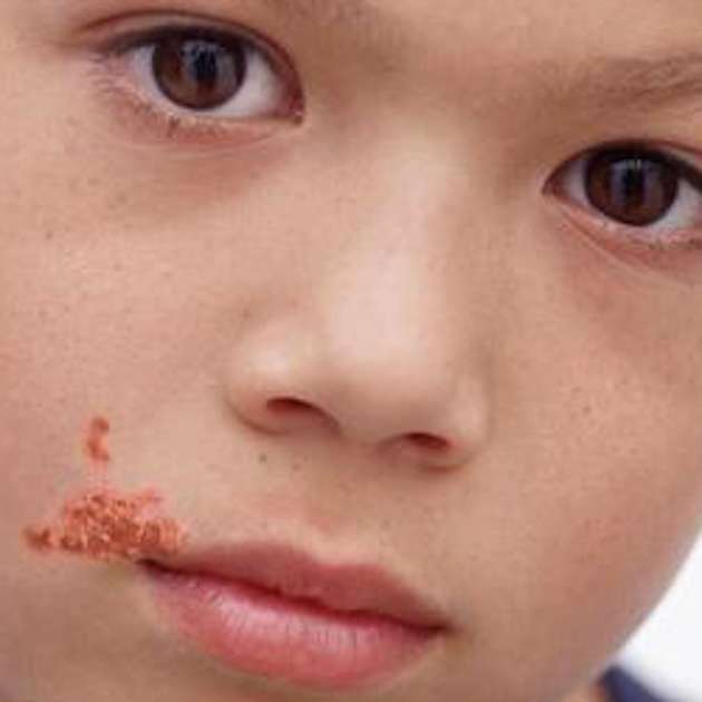 Impetigine sul labbro