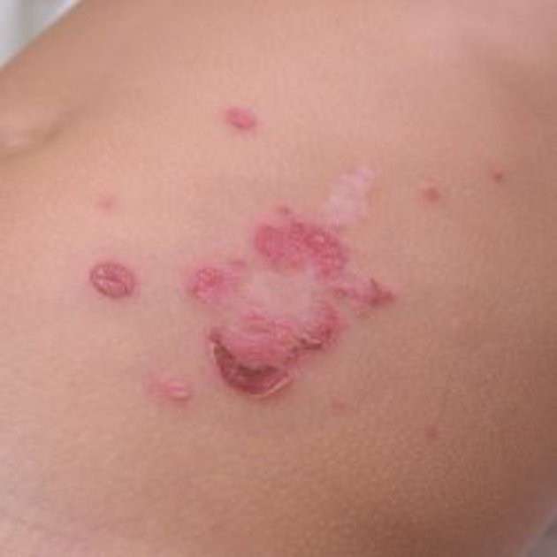 Impetigine sulla cute