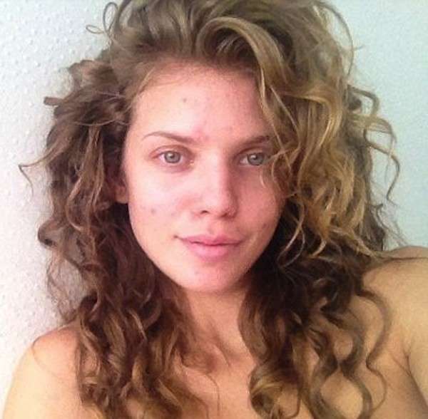 Annalynne McCord con acne