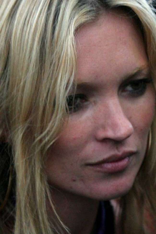 L'acne di Kate Moss