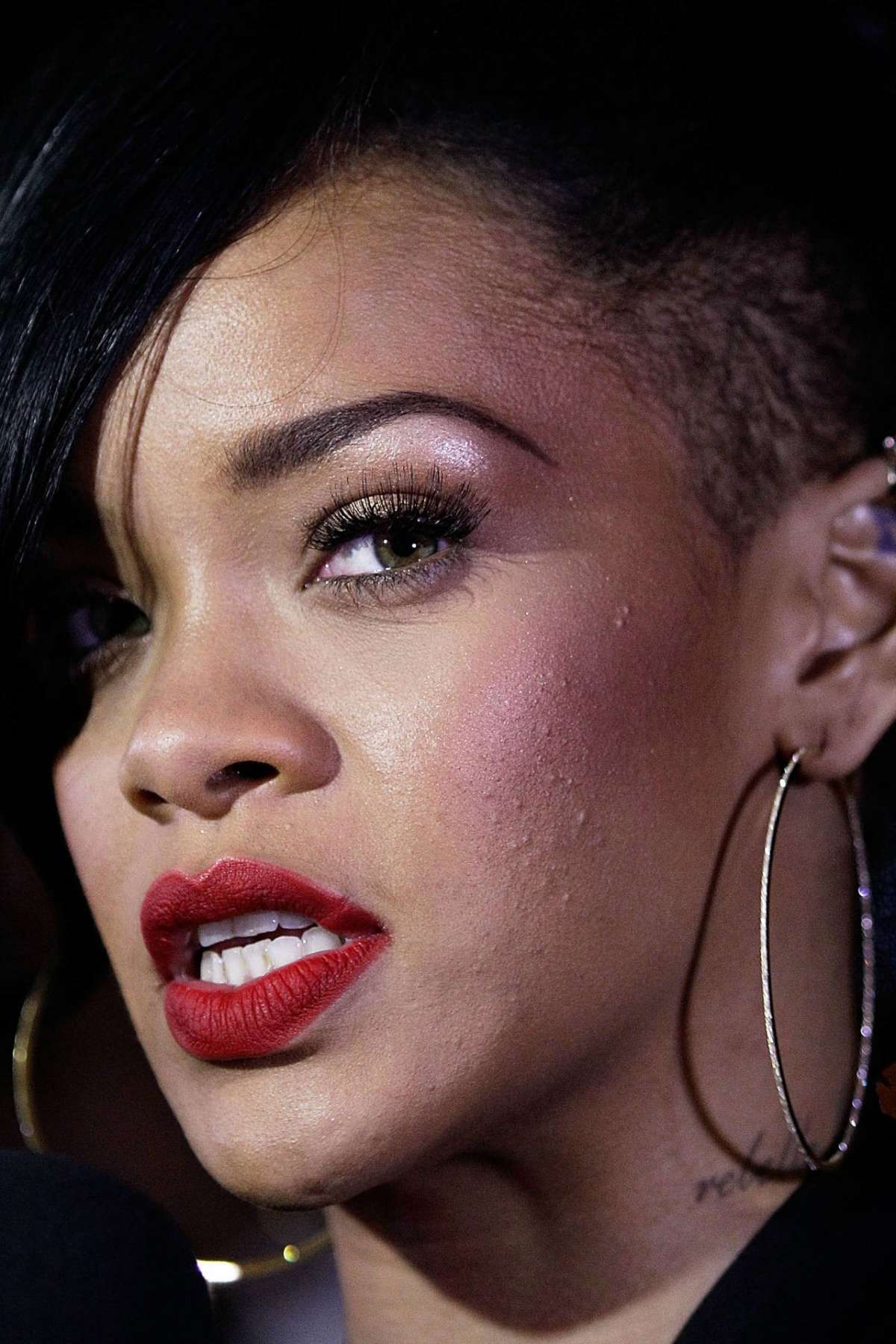 L'acne di Rihanna