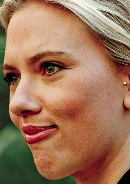 Leggera acne di Scarlett Johansson