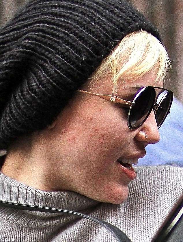 Miley Cyrus con acne
