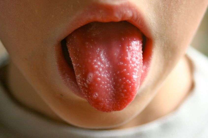 Sintomo della scarlattina sulla lingua
