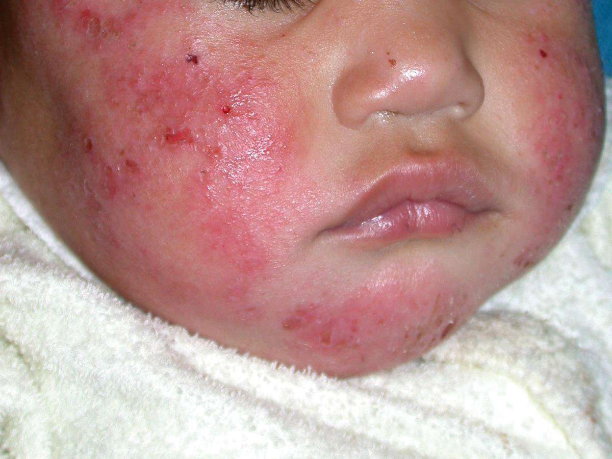 Dermatite atopica