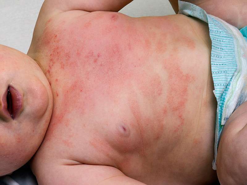 Eczema sul neonato