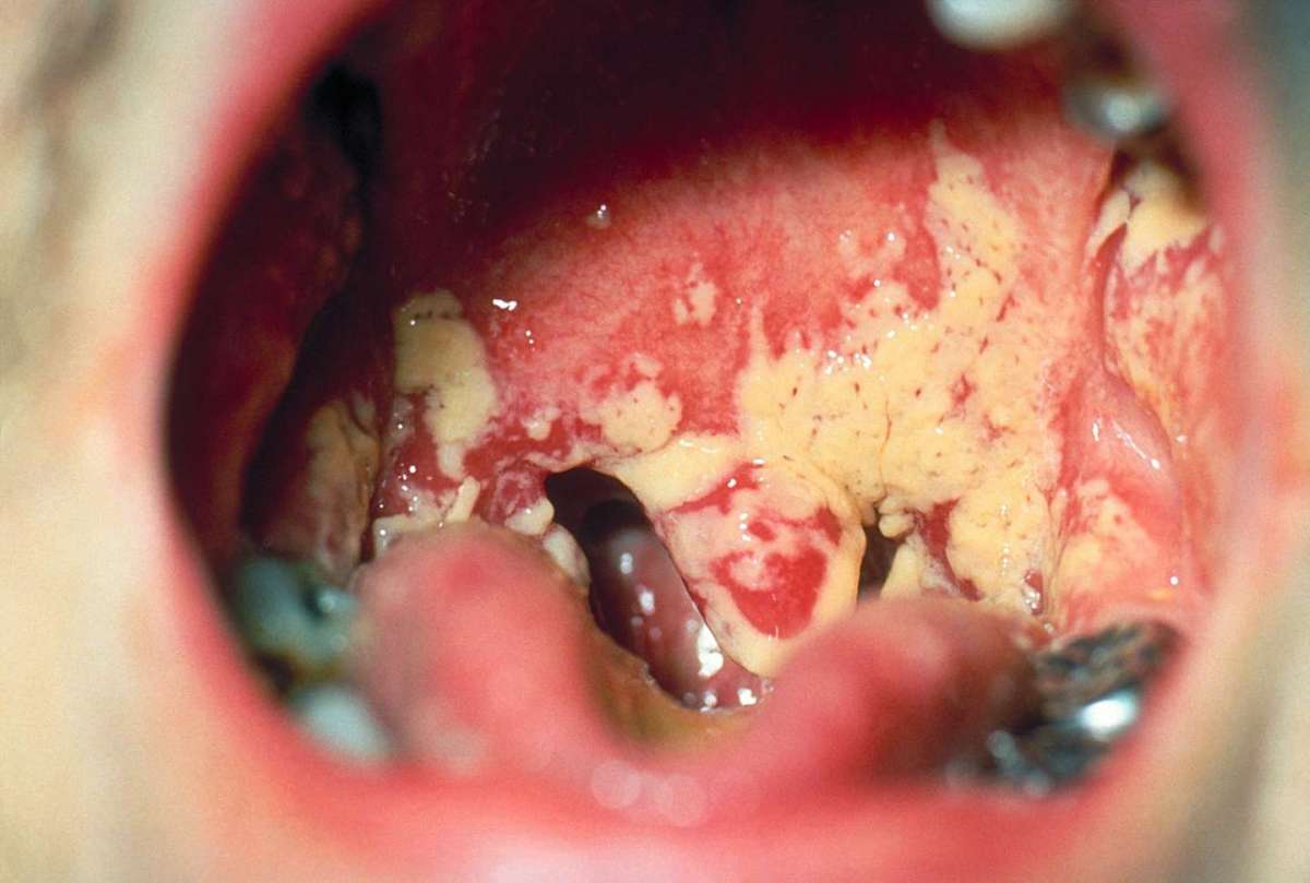Sintomi della candidosi orale